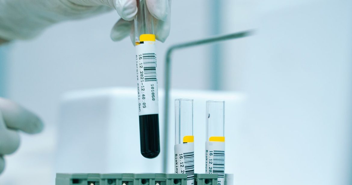 CircBioCare: Pioneering Early Knee OA Diagnosis