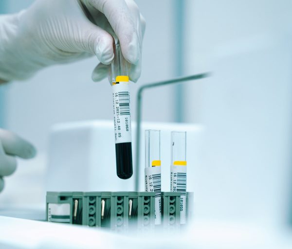 CircBioCare: Pioneering Early Knee OA Diagnosis
